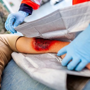 Burn Injuries: Causes, Liability, Compensation, and Legal Expertise Lawyer, Woodland Hills, California